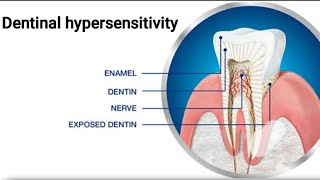 ImpforBds1styrexamDentinal hypersensitivity theories of pain transmission through dentin [upl. by Stetson]