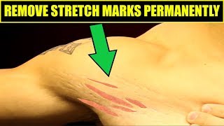 How To Get Rid Of Stretch Marks  4 Easy Tips To REMOVE STRETCH MARKS [upl. by Seldun]