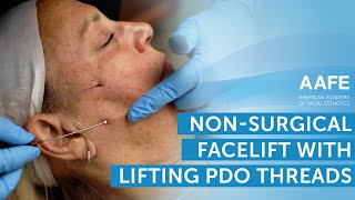 NonSurgical Facelift with Lifting PDO Threads  AAFE [upl. by Sonia]