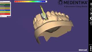 ASC Flex Rotation Exocad [upl. by Elocim]