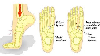 Lisfranc injury what’s new in lisfranc screw vs plates classificationdiagnostic technique [upl. by Japeth]