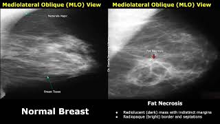 Mammography Normal Vs Abnormal Images  BIRADS Classification  Breast Cancer amp Other Diseases [upl. by Einnad]