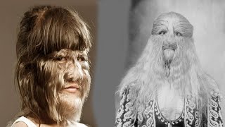 The TERRIFIC History of Hypertrichosis [upl. by Letney872]