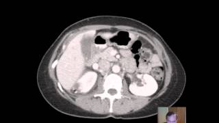 CT Pyelonephritis DISCUSSION [upl. by Rhea]