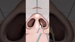 ASMR Remove unmanaged piercing pus animation  Squeeze nose acne asmr shorts [upl. by Karine]