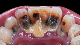 Deep Cleaning With HEAVY Tartar Build Up At The Dentist [upl. by Asia341]