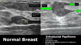 Breast Ultrasound Normal Vs Abnormal Image Appearances Comparison  BIRADS Classification USG [upl. by Ellecrad688]