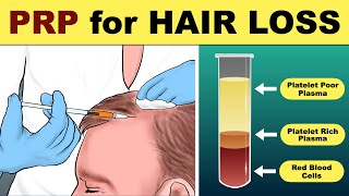 PRP Hair Treatment  prp hair loss treatment before and after  Hair loss Treatment [upl. by Eimam]