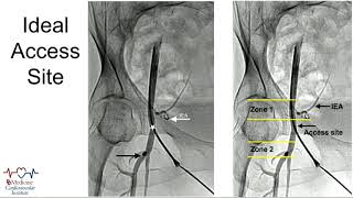 CVI 2019Thursday 718 PCI how to part 1 the basicsMazen AbuFadel MD [upl. by Ames168]