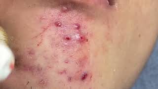 Acne Treatment Huong Da Nang  2024 blackheads 705 [upl. by Nilcaj]