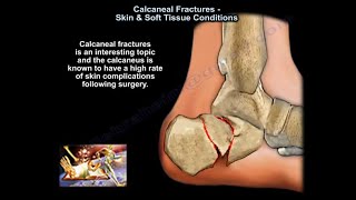 Calcaneal Fractures Skin amp Soft Tissue Condition  Everything You Need To Know  Dr Nabil Ebraheim [upl. by Mosora162]