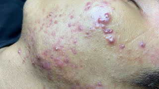 ACNE TREATMENT VU QUYNH MI  Blackheads Of Tweens 2024 EX [upl. by Olnay]