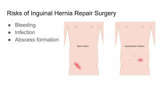 Inguinal Hernia Repair Surgery Risks and Outcomes  CHI Health [upl. by Atnuahsal340]