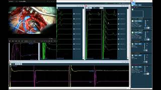 IONM for Microvascular decompression surgery [upl. by Siseneg]