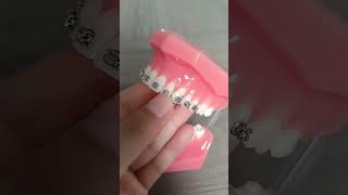 orthodontistselfligating brackets medical products [upl. by Fishbein]