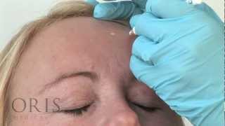 Botox Training  Frontalis  Oris Medical [upl. by Orvas503]