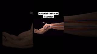 Arterial catheter insertionshorts ytshort anesthesia [upl. by Maxie]