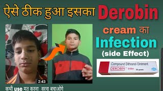 ऐसे ठीक हुआ Derobin Cream का Infection Side Effect With full Detail [upl. by Ellehcar]