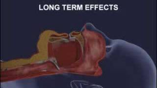 Introduction To Respironics CPAP CFlex Part 1 [upl. by Bellew]