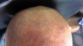 Impressie Micro Hair Pigmentation MHP behandeling bij Beauty Care Nederland BCN te Katwijk [upl. by Ravo467]