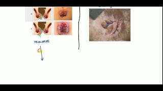 Hemorrhoids Lecture for USMLE [upl. by Proulx]