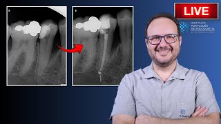 Endo Rtx of 🦷45 with EndoPerio Lesion ▶️ Single Session  CASE168 [upl. by Enobe]