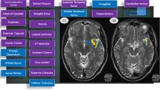 MRI Brain Sectional Anatomy Cut 11 amp 12 [upl. by Olva651]