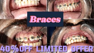 Ortho Braces Price in PakistanTooth Braces Cost in IslamabadBraces Before ampAfterBraces Process [upl. by Nerrat]