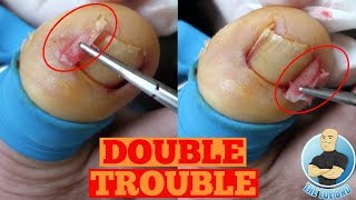 DOUBLE INGROWN TOENAIL REMOVAL FOREVERToe Nail Surgery by The Toe Bro [upl. by Ragg]