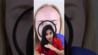 Pigmentary Demarcation Lines dermatologist dranvika transformation [upl. by Blondie]