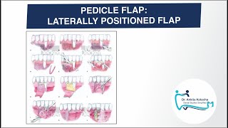 LATERALLY POSITIONED FLAPROTATIONAL PEDICLE FLAPSROOT COVERAGE TECHNIQUETECHNIQUES CLASSIFICATION [upl. by Shell824]