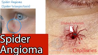 Spider Angioma  Capillaries on the face Spider spider telangiectasia Causes and Treatment [upl. by Tavia]