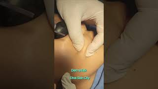 Mole Removal with Blade and Co2 Laser [upl. by Romonda371]