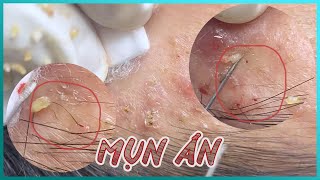 Big Cystic Acne Blackheads Extraction Blackheads amp Milia Whiteheads Removal Pimple Popping [upl. by Alexander]