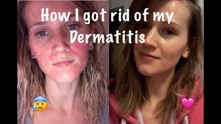 How I Cured My Perioral Dermatitis [upl. by Ardnazil787]