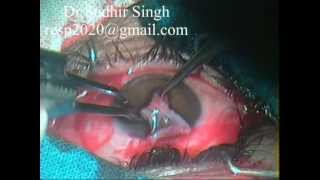 Conjunctival Graft Harvesting For Pterygium Excision With Autograft By Dr Sudhir Singh 32 [upl. by Akener]