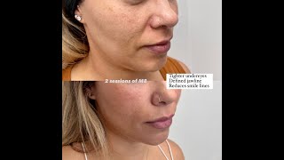 Botox in Los Angeles CA  Skin Tightening Botox and Lip Fillers by Skinsation LA [upl. by Louth]