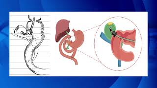 The worlds first endoscopic radical resection of early bile duct cancer [upl. by Seleta401]