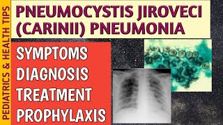 Pneumocystis Jiroveci Pneumonia P Carinii Symptoms Radiology Treatment amp Prophylaxis [upl. by Noach]