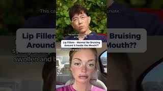 Dr Lennard Chan Reacting to Lip Filler Bruising [upl. by Euh]