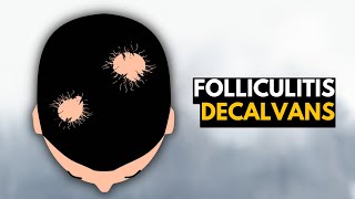 Folliculitis Decalvans What You Need To Know [upl. by Clynes]