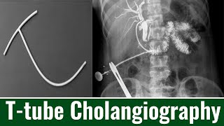 Ttube Cholangiography When is Ttube Cholangiography Performed Cholangiogram Purpose amp Procedure [upl. by Edahs317]