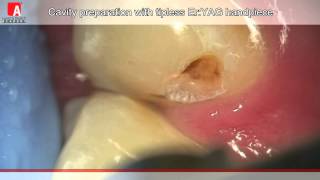 CAVITY PREPARATION Fotona Lightwalker ErYAG laser [upl. by Serrell]