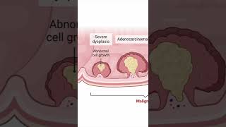 Evolução do pólipo para câncer colorectalcancerawareness cancer colonoscopia [upl. by Neoma]