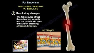 Fat Embolism  Everything You Need To Know  Dr Nabil Ebraheim [upl. by Eniamej]