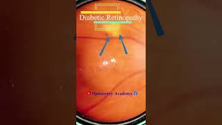 Diabetic retinopathy  cotton wool spots  Fundus  Short Video 172 optometryacademy akleshkumar [upl. by Dust]