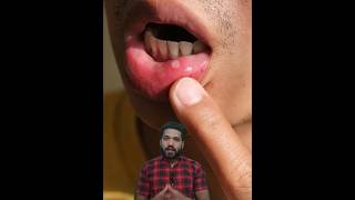 4 Home remedies for mouth ulcers मुँह के छाले घर पर ठीक करें 👍🏻😊shorts [upl. by Ortrude]