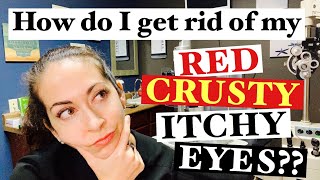 Blepharitis  2 Easy steps to banish red crusty itchy eyes  The Eye Surgeon [upl. by Adieno]