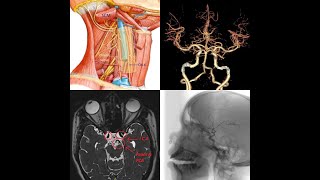 Part 1INTERNAL CAROTID ARTERYClinical amp Surgical anatomyReal time ArteriographyMRI amp CT Angio [upl. by Afnin315]