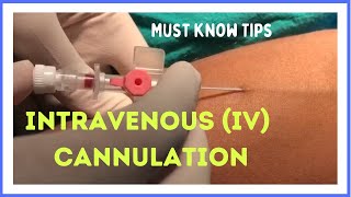 INTRAVENOUS IV CANNULATION in 5 mins How to insert [upl. by Margreta]